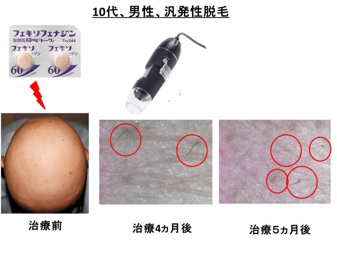 円形脱毛症　病院